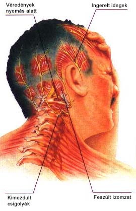 headache-01_419_01